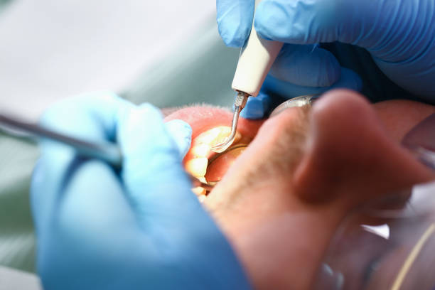 Best Emergency Wisdom Teeth Removal in Utica, MI